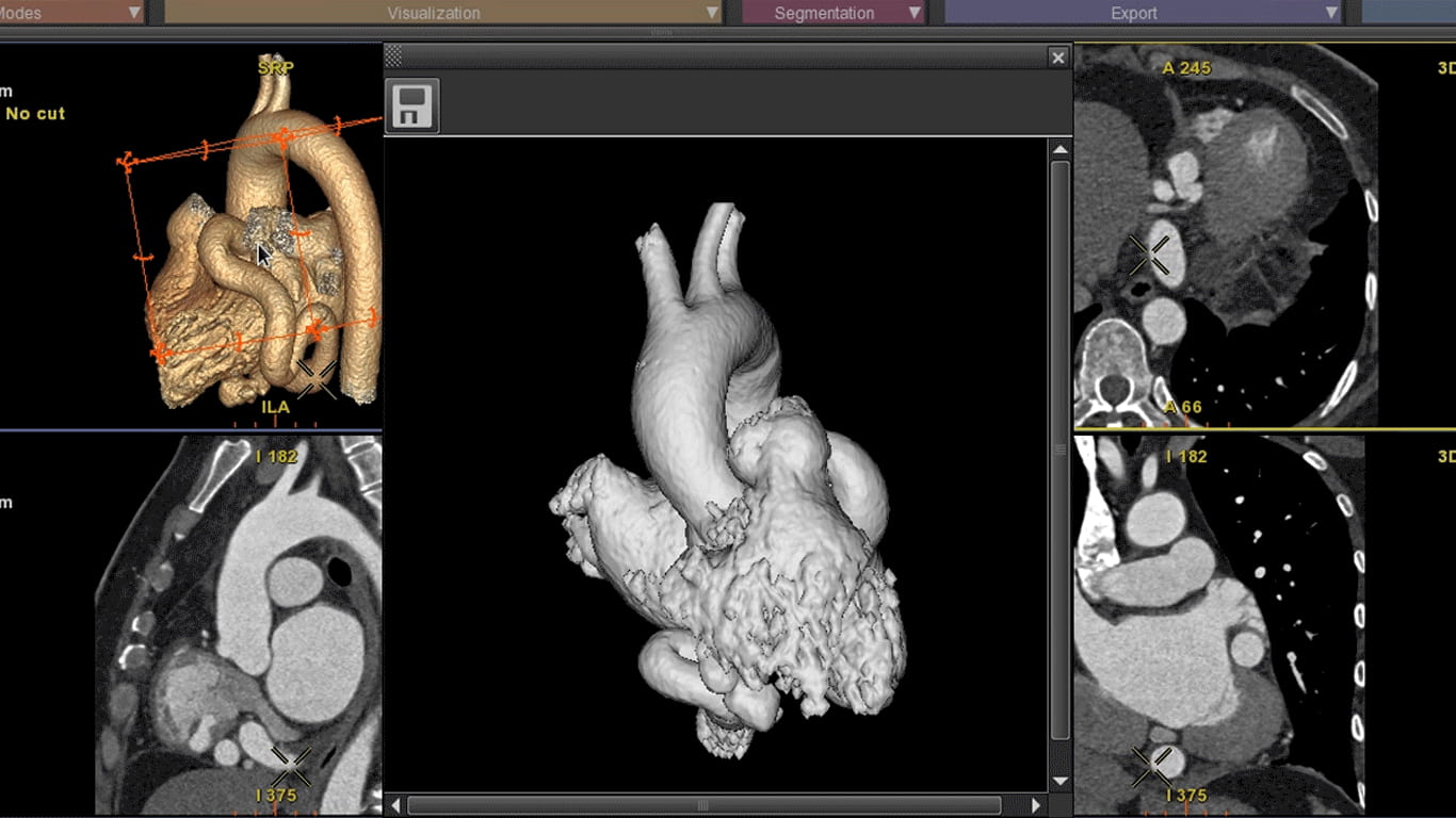 3D Printing fistula